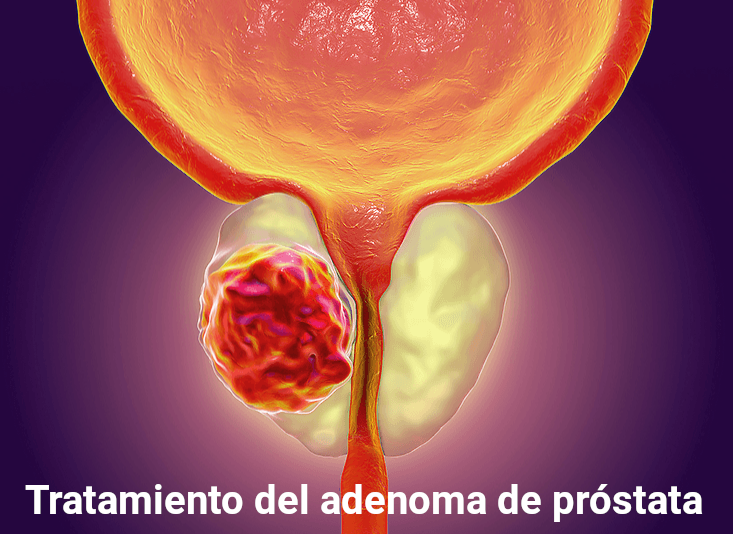 tratamiento del adenoma de próstata avodart